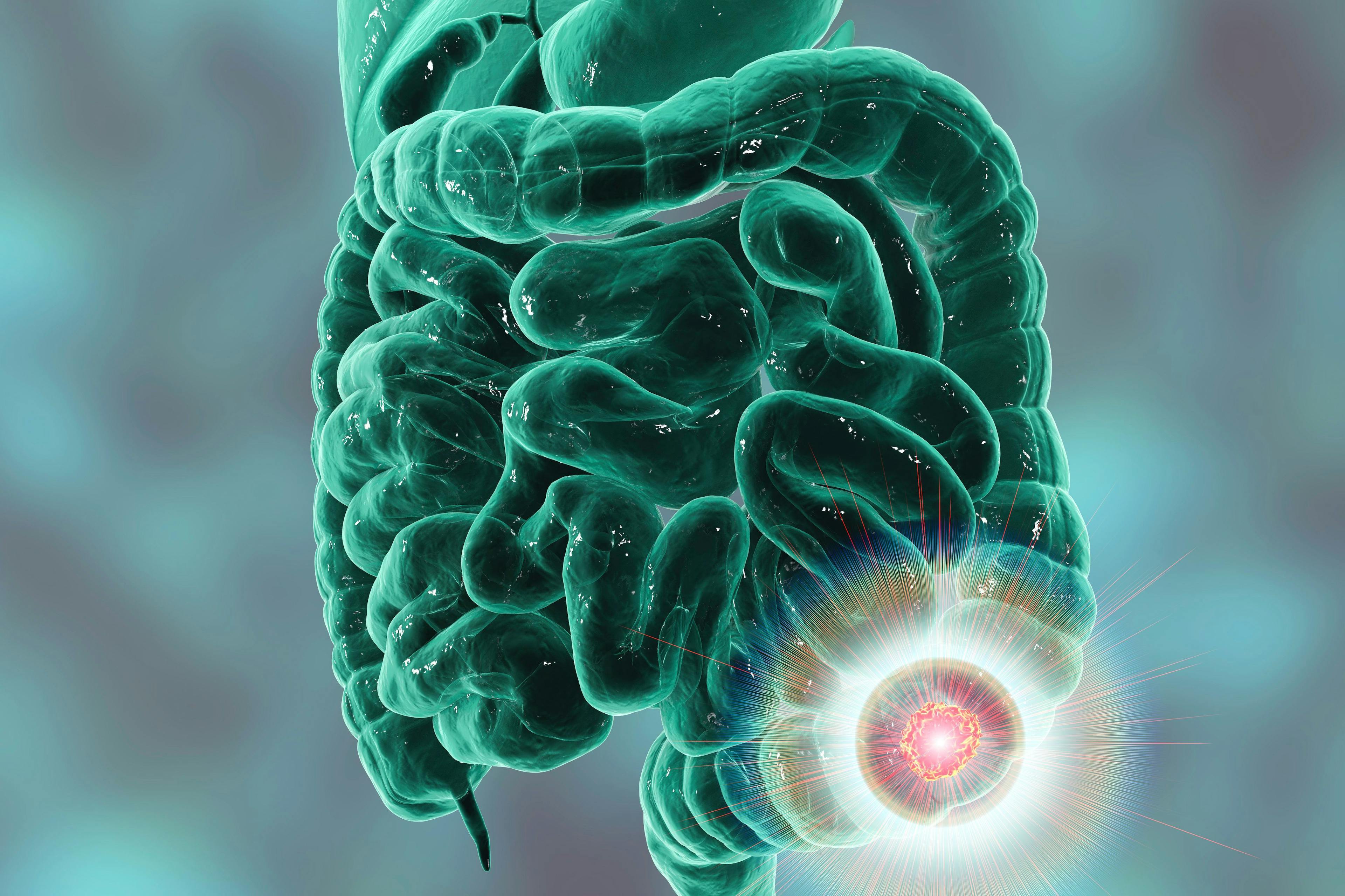 Image credit: Dr_Microbe | stock.adobe.com. Colorectal cancer awareness medical concept. Concept of cancer treatment and prevention, 3D illustration