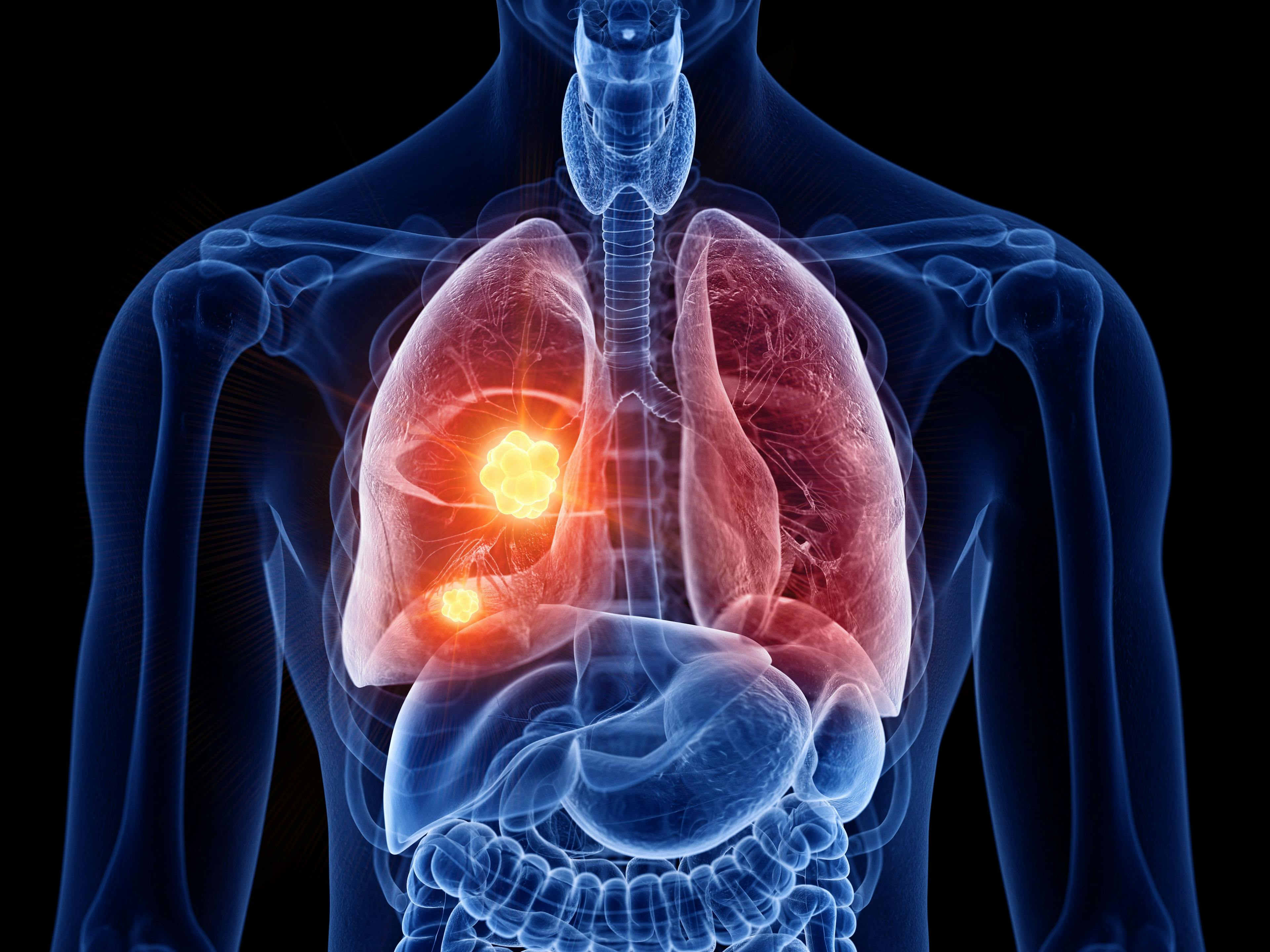 Image credit: SciePro | stock.adobe.com. 3d rendered illustration of lung cancer 3D illustration