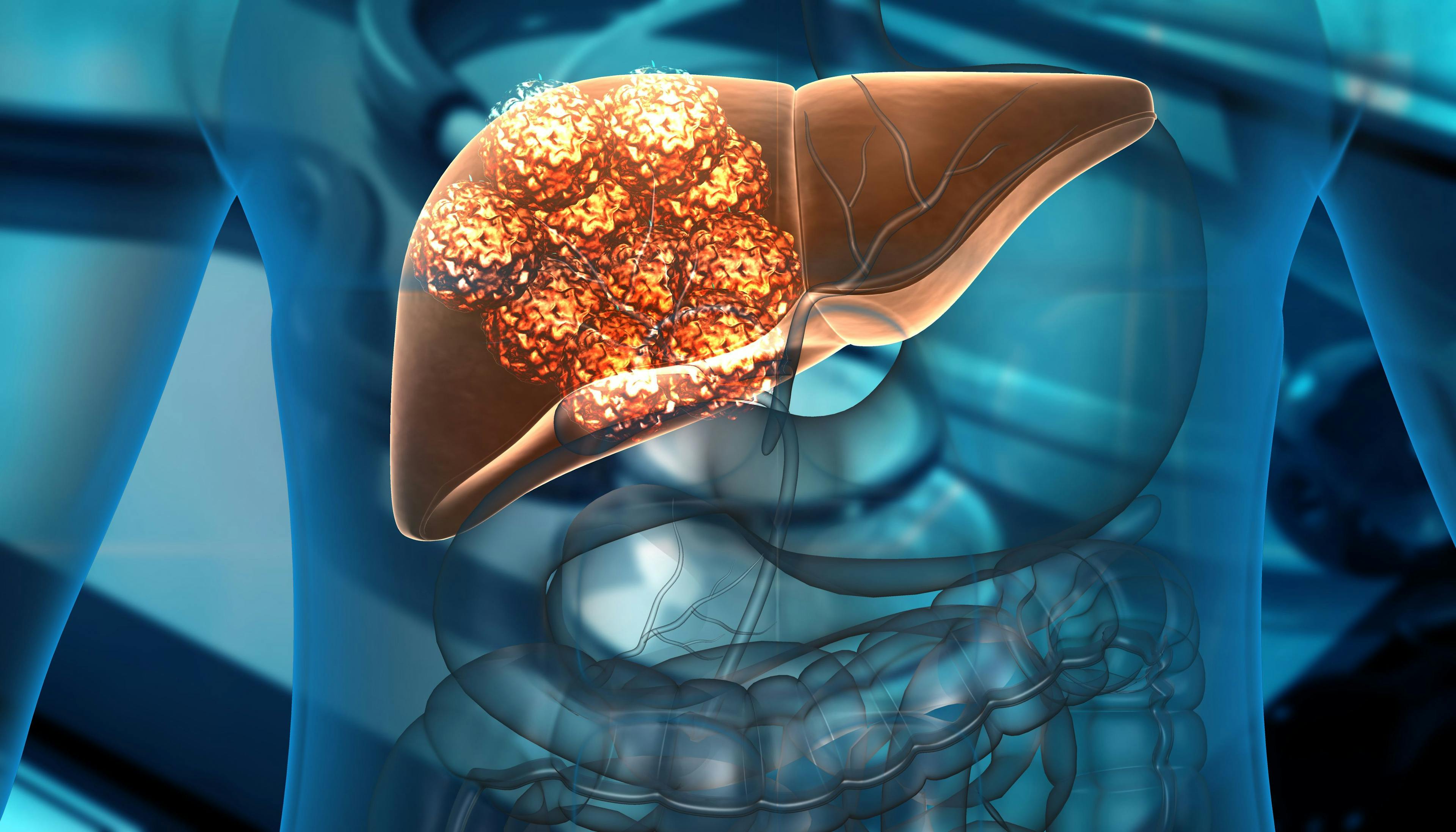 FDA Fast Tracks Early Stage Novel Tumor-Infiltrating Lymphocyte Therapy 