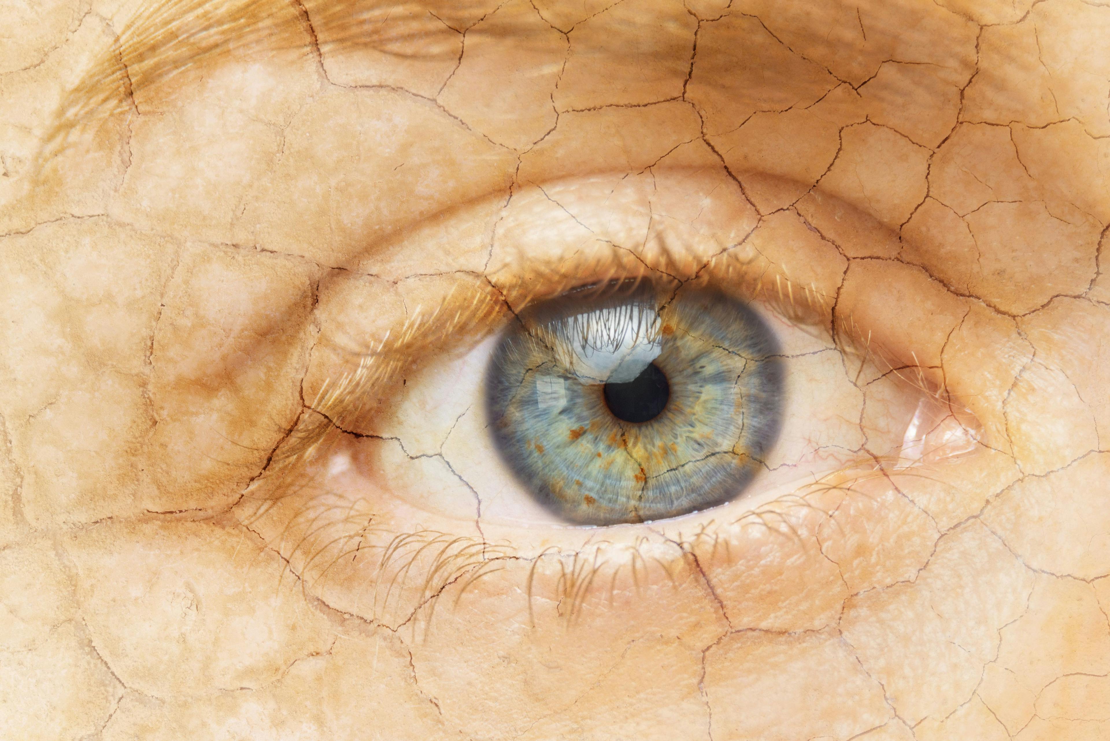 Image credit: herraez | stock.adobe.com. Cracked Skin. Closeup of a female eye with cracked skin. Aging process or pain and loneliness conceptual image.