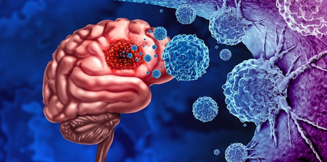 Image credit: freshidea | stock.adobe.com. Glioma Cancer Tumor as malignant cells outbreak as a brain disease attacking neurons as a medical concept of neurological disease